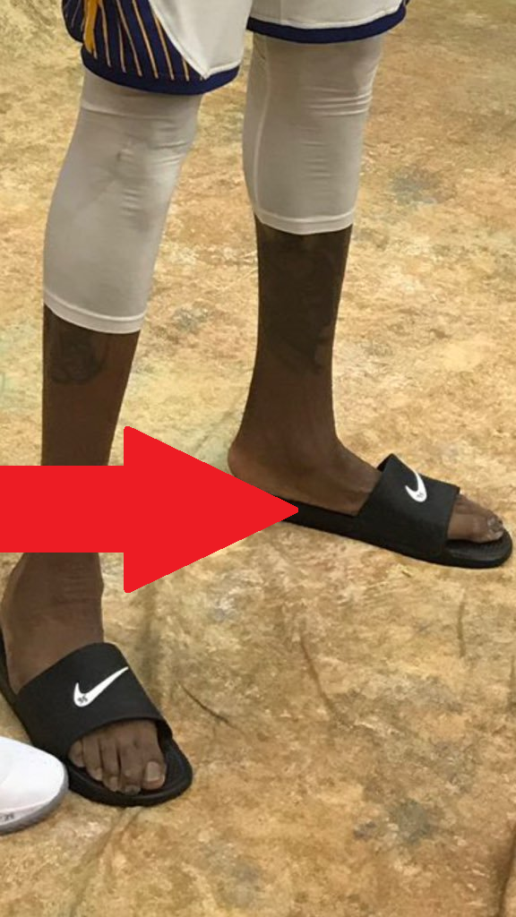 Is Kevin Durant's flat deformed foot 