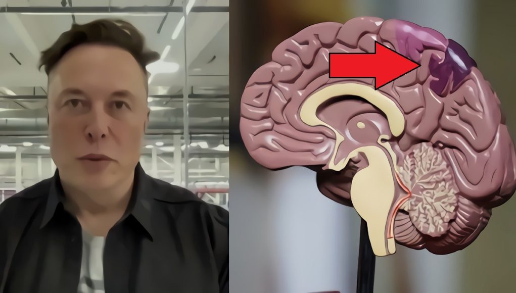 Elon Musk Reveals When Neuralink Brain Chip Implants Will Be Implanted In Human Brains