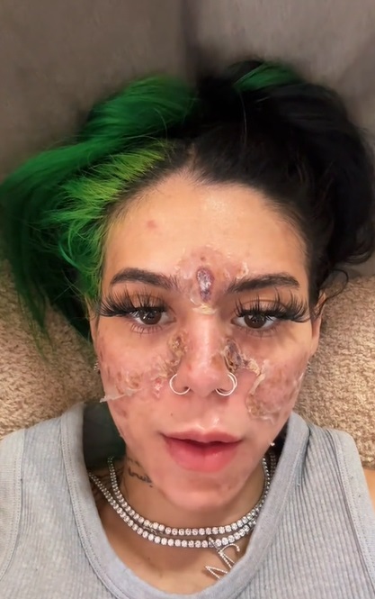 Beasteater claims her Chemical Burns came from using an expired skin care product